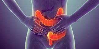 CÁNCER COLORRECTAL
