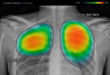 GE Healthcare lanza nuevo sistema de inteligencia artificial para detectar anomalías en radiografías torácicas, como la neumonía causada por COVID-19 radiografías torácicas