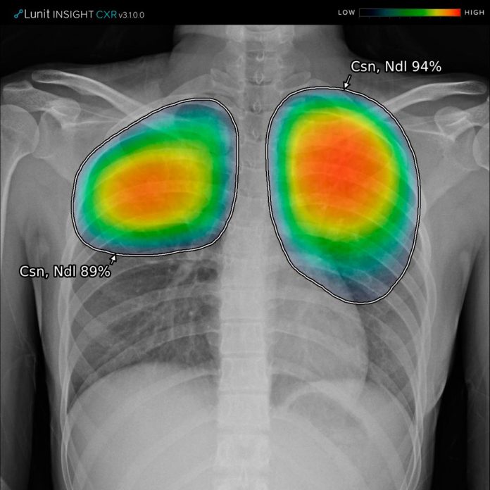 radiografías torácicas