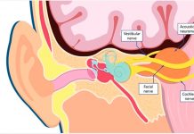 Tratamiento de Tumores Cerebrales con Radiocirugía Tratamiento de Tumores Cerebrales con Radiocirugía