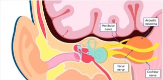 Tratamiento de Tumores Cerebrales con Radiocirugía