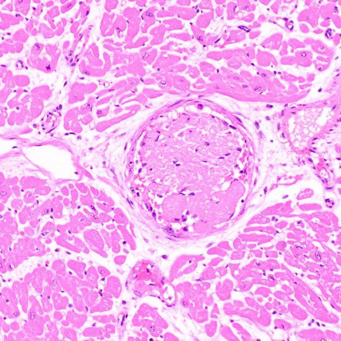 Mayo Clinic: Frecuencia de coágulos sanguíneos en el corazón de pacientes con COVID-19