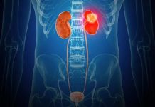 Cáncer renal: un cáncer silencioso que va en aumento
