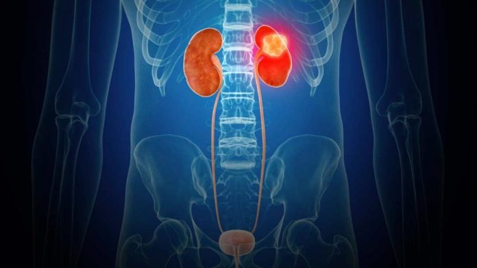 Cáncer renal: un cáncer silencioso que va en aumento