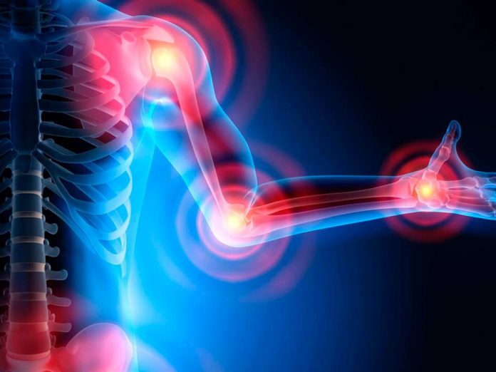 Investigadores de Mayo desarrollan algoritmo para predecir actividad de la artritis reumatoide