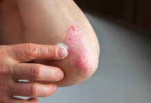 Encuesta a pacientes de psoriasis entrega reveladores datos sobre esta patología en Chile  