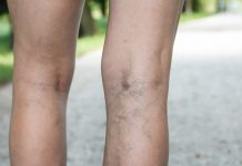 Uno de cada 10 adultos jóvenes presentan coágulos venosos que podrían provocar la muerte Uno de cada 10 adultos jóvenes presentan coágulos venosos que podrían provocar la muerte