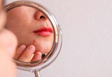 Acné: consejos clave para tratar correctamente esta enfermedad