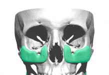 implante craneal de hueso sintético