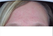 Mitos y verdades sobre la rosácea No todas las pieles rojizas tienen rosácea