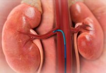 Denervación Renal hipertensión arterial