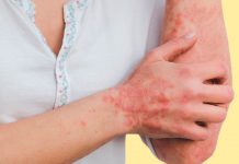 psoriasis en Chile