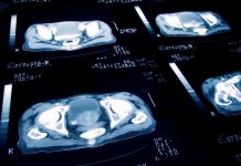 Janssen muestra su compromiso en el desarrollo de medicina de precisión, terapias dirigidas y plataformas novedosas en Oncología