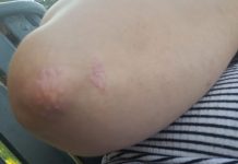 psoriasis placa codo