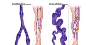 ¿Pueden las venas varicosas causar dolor en la pierna? Venas varicosas
