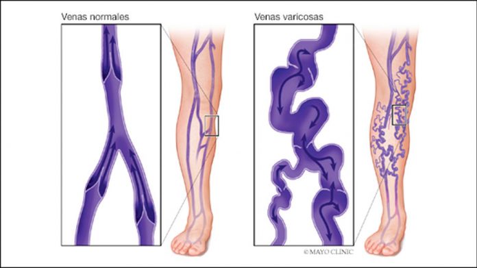 Venas varicosas Venas varicosas