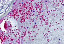 484 casos de viruela del mono en Chile: ¿Se contagia por contacto sexual? Mitos viruela del Mono