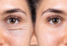 BLEFAROPLASTIA el tratamiento para tener una increíble mirada