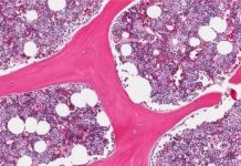 Cinco avances clave en los trasplantes de médula ósea