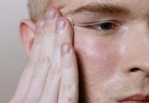 Consejos para cuidar la piel grasa en verano