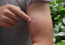 Los 10 problemas de salud más frecuentes del verano Los 10 problemas de salud más frecuentes del verano