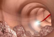 Experto de Mayo Clinic Healthcare: la inteligencia artificial mejora la precisión de la colonoscopia