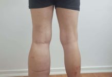 Día Mundial del Linfedema: la dolorosa y desconocida enfermedad que puedes tener desde tu nacimiento o llegar tras un cáncer 