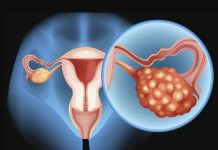 Investigadores de Mayo Clinic vinculan el cáncer de ovario con la colonización bacteriana en el microbioma