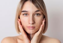 Hiperpigmentación: cómo disminuir las manchas en la piel