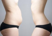 Dile adiós al cuerpo de mamá con estos innovadores tratamientos