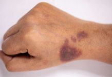 Hemofilia: la enfermerdad genética que provoca hematomas y que se hereda del cromosoma x de las mujeres