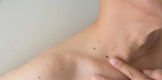 Los hombres deben tomarse en serio el melanoma