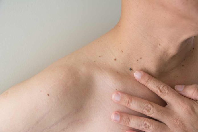 Los hombres deben tomarse en serio el melanoma