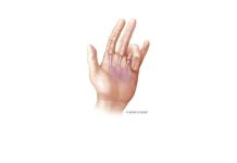 ¿Qué desencadena el dedo en gatillo