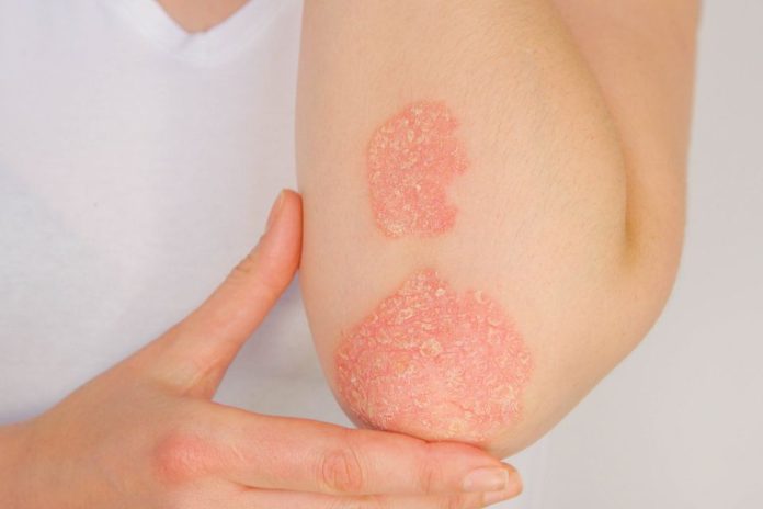 El Instituto de Salud Pública (ISP) de Chile aprobó un nuevo medicamento para la psoriasis moderada a severa