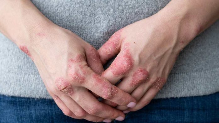 ¿Qué es la psoriasis?: las cuatro claves para entender la enfermedad que afecta al 2% de los chilenos