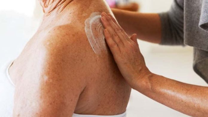 Incontinencia en la piel: una dermatitis más común de lo que se piens