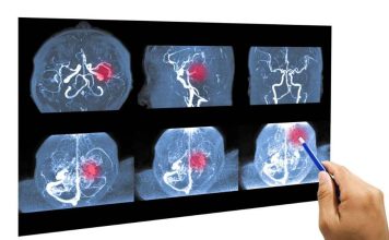 Día Mundial del Accidente Cerebrovascular: Qué hacer cuando ocurre y cómo prevenirlo