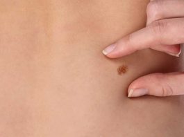 La Roche-Posay realizará operativo de chequeo de lunares gratuito para detectar y prevenir el cáncer de piel La Roche-Posay realizará operativo de chequeo de lunares gratuito para detectar y prevenir el cáncer de piel