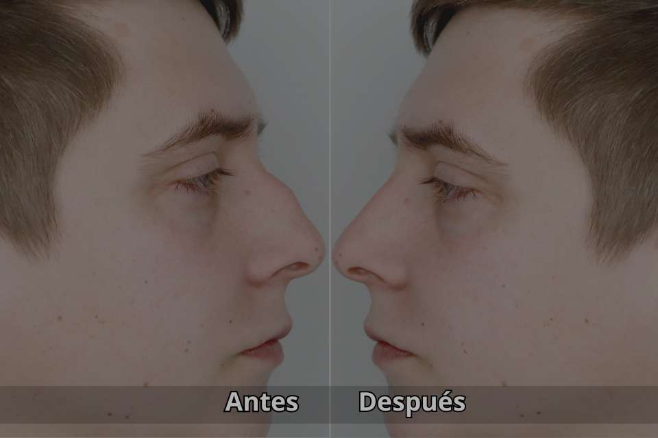 Rinoplastia hombre, antes y después