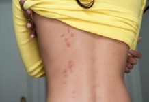 Alergias y picaduras: ¿cuándo poner atención? Alergias y picaduras: ¿cuándo poner atención?