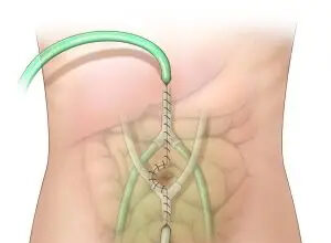 Los nuevos baños de medicamentos calentados brindan esperanza a los pacientes con cáncer de estómago