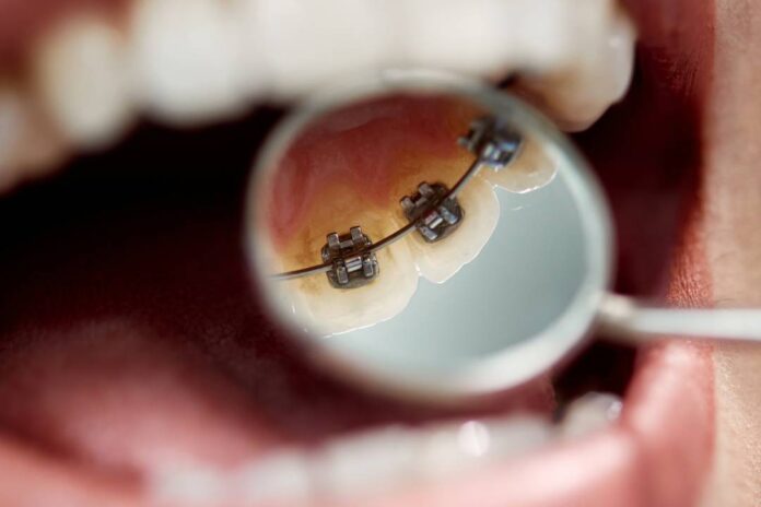 https://portalprensasalud.cl/2024/05/10/ortodoncia-lingual-la-innovadora-tecnologia-que-permite-tener-brackets-100-invisibles/