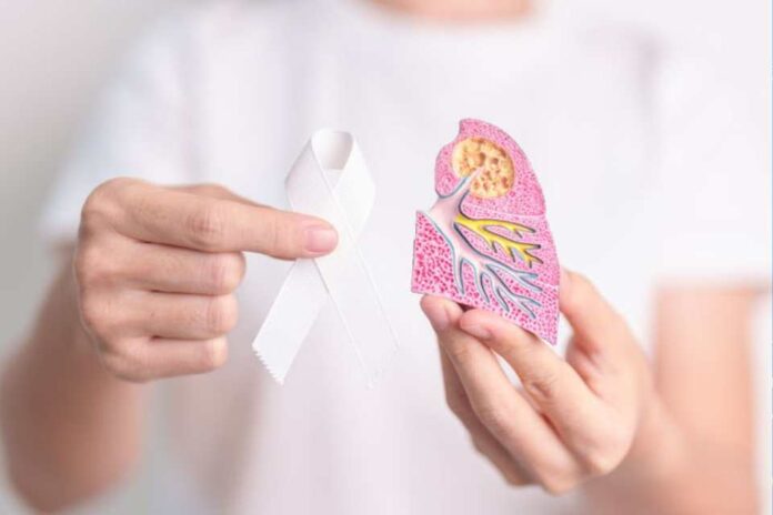 60% de los pacientes con cáncer de pulmón avanzado ALK positivo viven más de cinco años sin progresión de la enfermedad