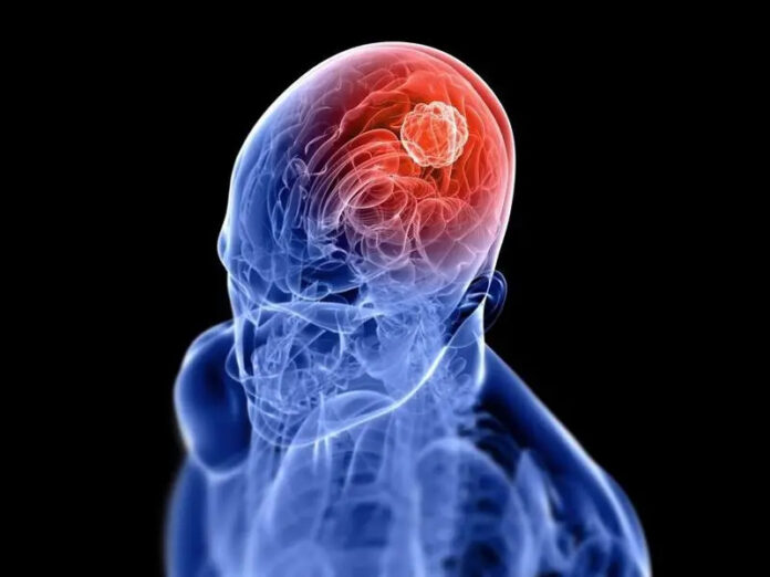 Nueva plataforma de investigación evalúa mutaciones del cáncer cerebral durante la cirugía JACKSONVILLE, Florida — Tratar un cáncer cerebral se vuelve complicado cuando comienza a crecer, y un tipo frecuente, conocido como glioma, tiene una baja tasa de supervivencia a cinco años. En un nuevo estudio publicado por Proceedings of the National Academy of Sciences, investigadores de Mayo Clinic informan sobre una nueva plataforma quirúrgica utilizada durante las cirugías que proporciona información importante para la toma de decisiones sobre el tratamiento del tumor en cuestión de minutos. Cuando se trata de tumores malignos y agresivos, el tiempo se convierte en un factor crucial. La plataforma utiliza espectrometría de masas para identificar una mutación genética clave en el cáncer cerebral, conocida como mutaciones de isocitrato deshidrogenasa (IDH), en tiempo real. La espectrometría de masas es una técnica sensible utilizada para analizar sustancias en muestras de tejido, incluidas las alteradas por el cáncer. El estudio incluyó más de 240 pequeñas biopsias de tejido de pacientes sometidos a la cirugía cerebral despierta y durmientes con sospecha de glioma en Mayo Clinic entre 2021 y 2023, y 137 biopsias adicionales provenientes de un colaborador internacional. Los neurocirujanos tomaron muestras de biopsia del núcleo del tumor para identificar las mutaciones, así como de las áreas a su alrededor, para evaluar si el tumor se había diseminado. Cada muestra de tejido se colocó en un portaobjeto de vidrio cerca del paciente durante la cirugía. Las muestras se analizaron mediante el espectrómetro de masas, que permitió a los investigadores evaluar rápidamente — en menos de dos minutos — si estaba presente una mutación IDH. Los investigadores dicen que, además de permitir el diagnóstico en tiempo real, la plataforma permite a los cirujanos determinar el pronóstico de un paciente y realizar la resección del tumor para mejorar los resultados del paciente. En el futuro, la nueva plataforma ayudará a los cirujanos a aprovechar las oportunidades en el quirófano, con el fin de adaptar el tratamiento a las características moleculares de un tumor, un enfoque más personalizado de la medicina. Los investigadores esperan que las nuevas terapias desarrolladas para atacar las mutaciones de IDH puedan administrarse en el quirófano en el momento de la cirugía. 