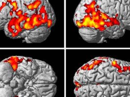Investigadores identifican cambios vasculares en el cerebro relacionados con la enfermedad de Alzheimer