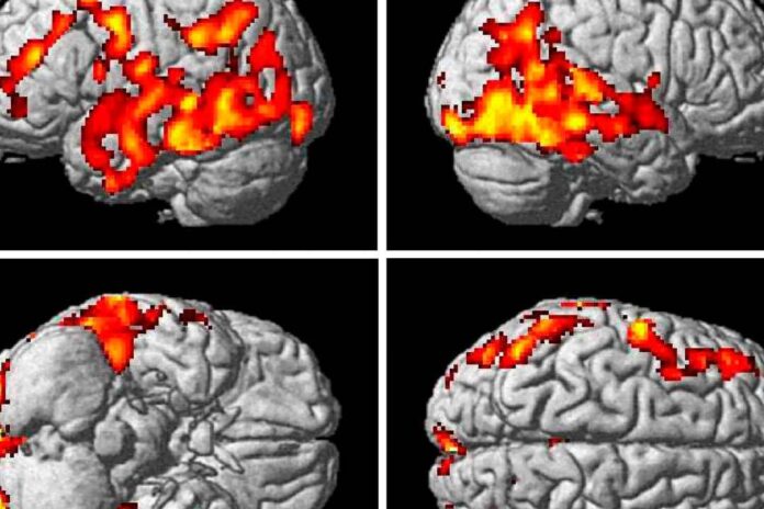 Investigadores identifican cambios vasculares en el cerebro relacionados con la enfermedad de Alzheimer