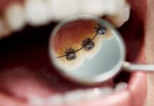 Ortodoncia Lingual: Mitos y verdades de esta innovadora solución para tener una sonrisa perfecta  Ortodoncia Lingual: Mitos y verdades de esta innovadora solución para tener una sonrisa perfecta