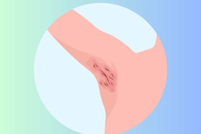 Subdiagnóstico y limitaciones para el acceso a terapias la dura realidad que viven los pacientes con hidradenitis supurativa en Chile