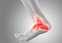 Avances en traumatología mejoran el tratamiento de fracturas en Chile Avances en traumatología mejoran el tratamiento de fracturas en Chile